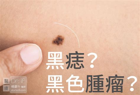 陰囊有痣|陰囊長痣？5大原因揭秘